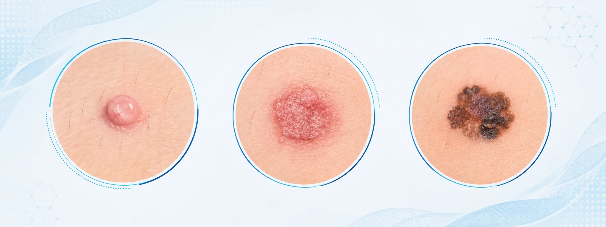 Comparación ilustrada de los tres tipos de cáncer de piel: carcinoma basocelular, espinocelular y melanoma