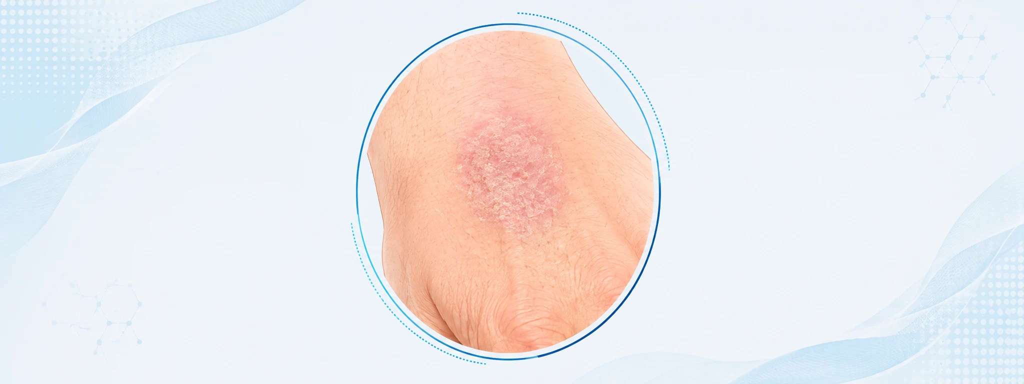 Ilustración de queratosis actínica: zona áspera y escamosa en piel expuesta al sol