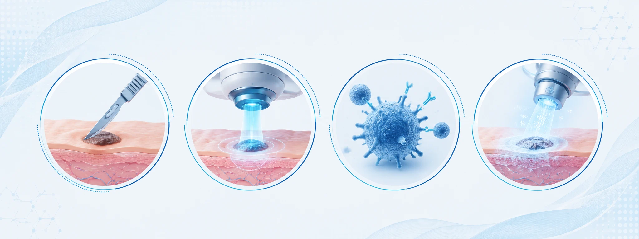 Opciones de tratamiento del cáncer de piel: cirugía, radioterapia e inmunoterapia